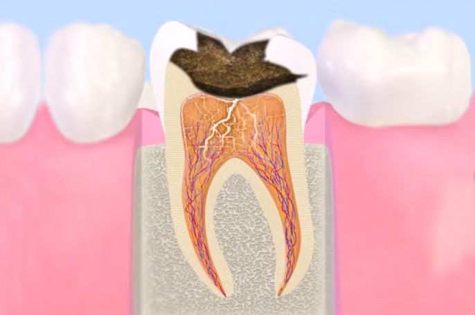 むし歯の発生要因