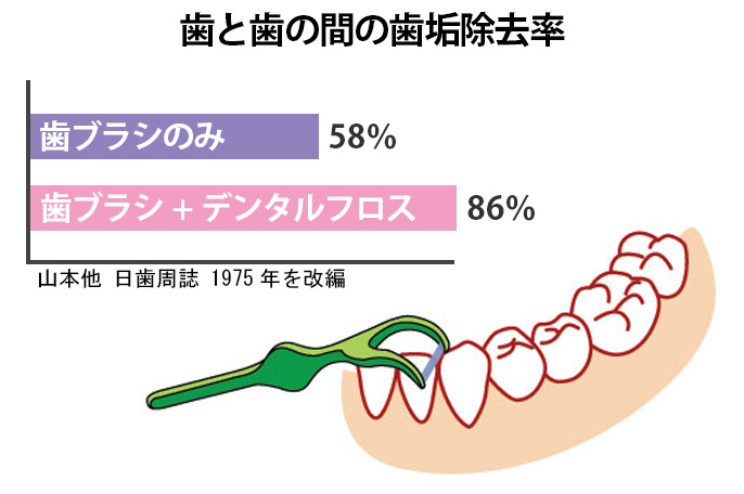 デンタルフロス併用の歯石除去率